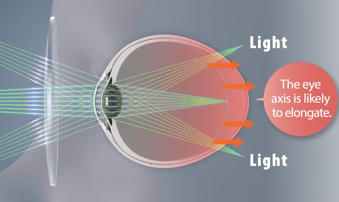 Conventional lens: light focuses behind the eyeball and the eye axis is likely to elongate.