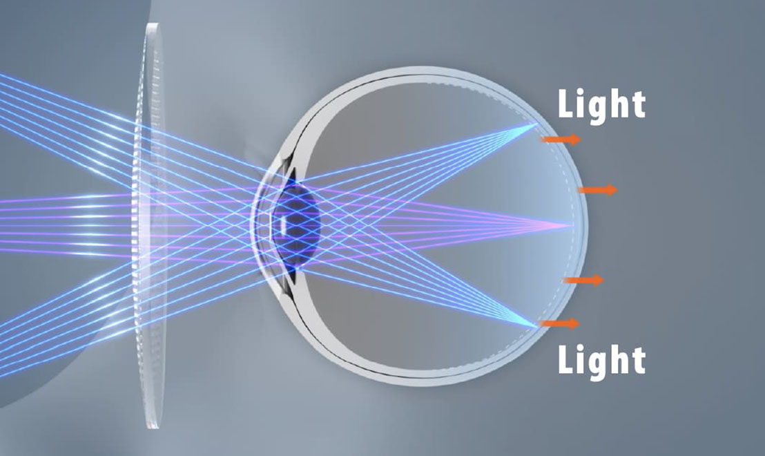 MYOGEN: the special lens shape controls the traveling direction of light so that it focuses in front of the retina.